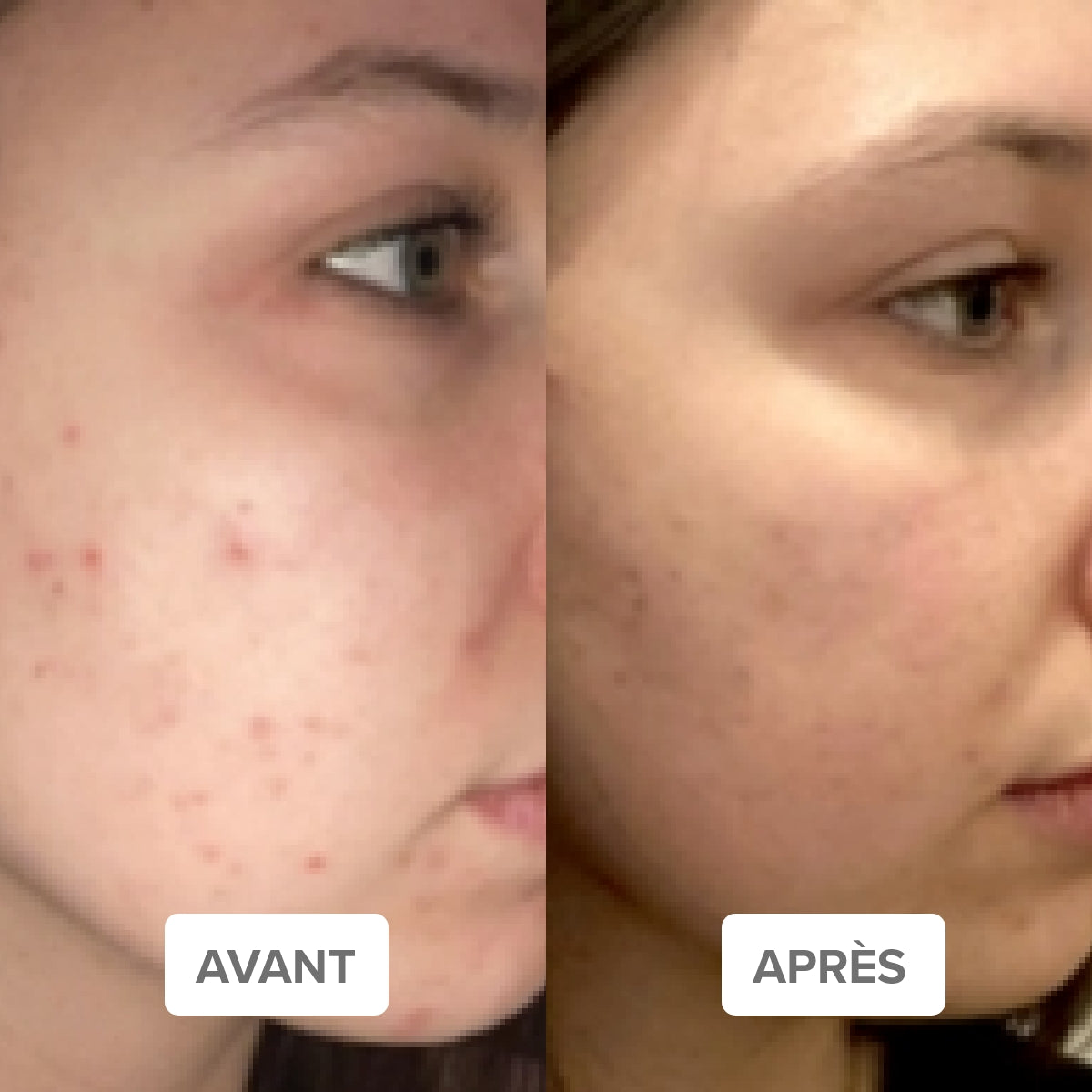 ZERO DEFECT SKIN ROUTINE - Acne-prone skin